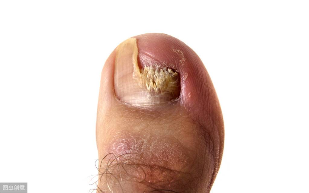 灰指甲症状早期图片