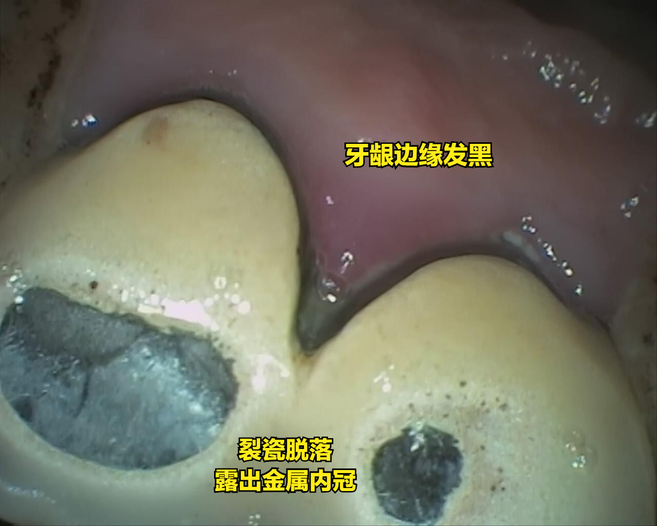 一般烤瓷牙价格（假牙套之烤瓷牙）(图1)