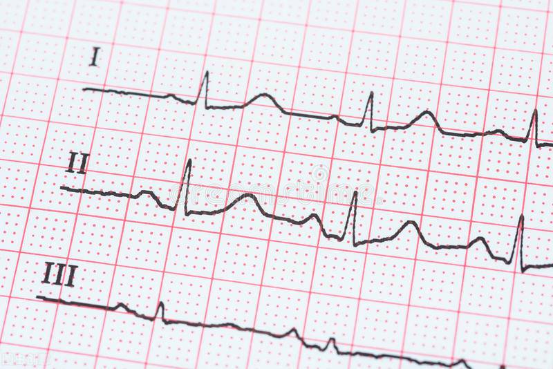 “窦性心律”是什么概念？引发窦性心律不齐的原因有3方面