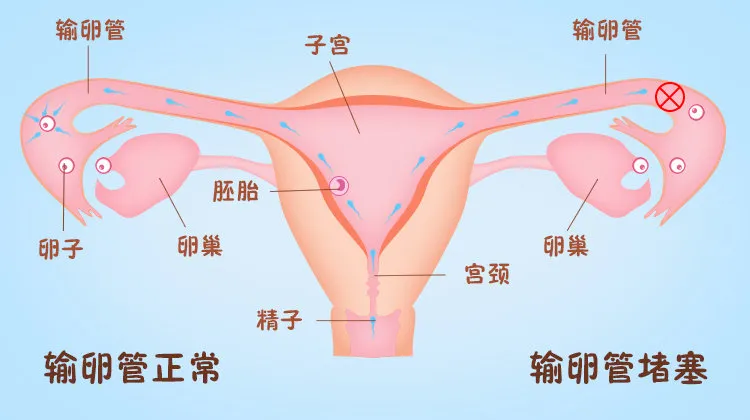 想知道输卵管通不通，你需要做什么检查？