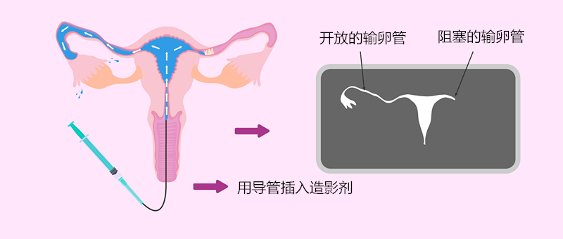 想知道输卵管通不通，你需要做什么检查？