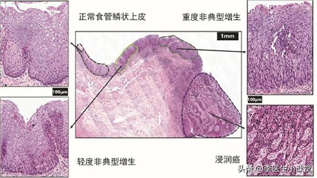 总是反酸烧心怎么办？三个小方法，帮你缓解胃食管返流