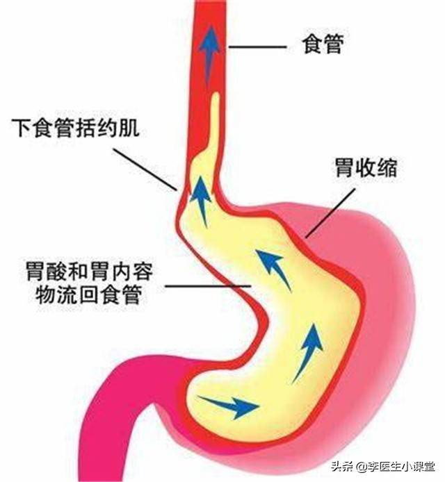 总是反酸烧心怎么办？三个小方法，帮你缓解胃食管返流