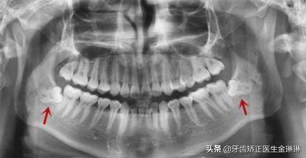 智齿疼吃什么药能好转？智齿吃什么药止疼最快