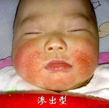 新生儿常见现象——湿疹