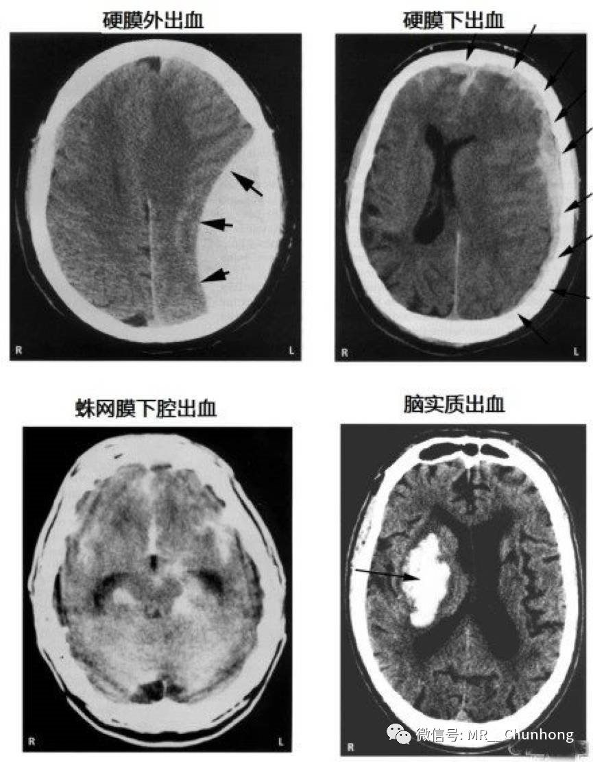 硬膜外与硬膜下出血的血来自哪里