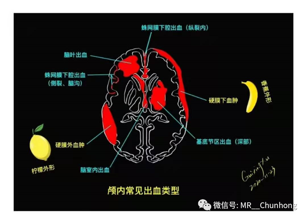 硬膜外与硬膜下出血的血来自哪里