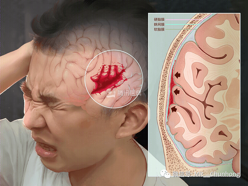 硬脑膜下出血图片