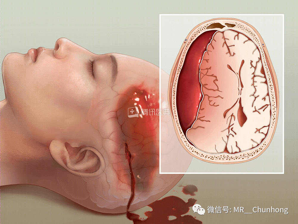 硬膜外与硬膜下出血的血来自哪里