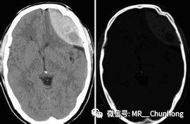 硬膜外与硬膜下出血的血来自哪里