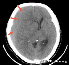 硬膜外与硬膜下出血的血来自哪里