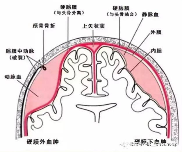 硬膜外与硬膜下出血的血来自哪里