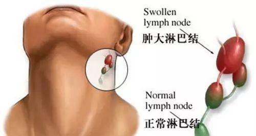 脖子上的“小肿块”——淋巴结肿大怎么办？