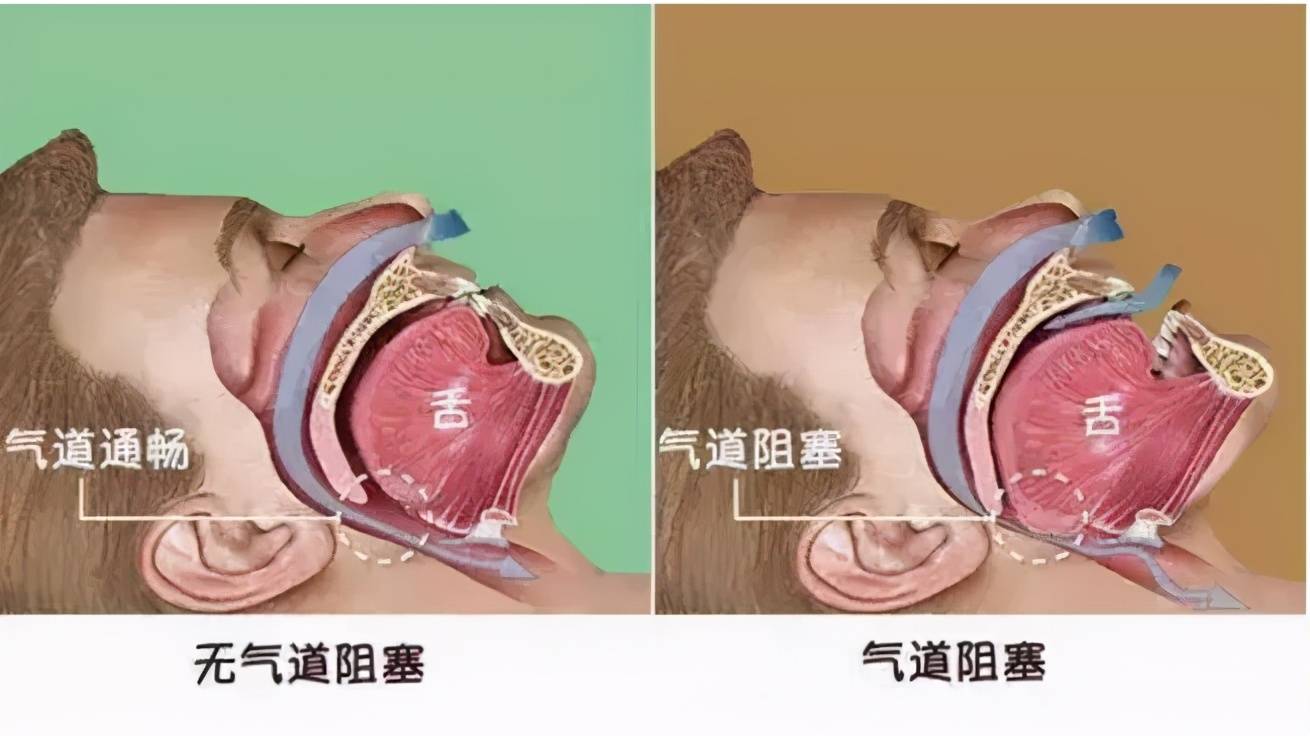 宝宝睡觉会打呼噜怎么办？多是4个原因引起，父母需要引起重视