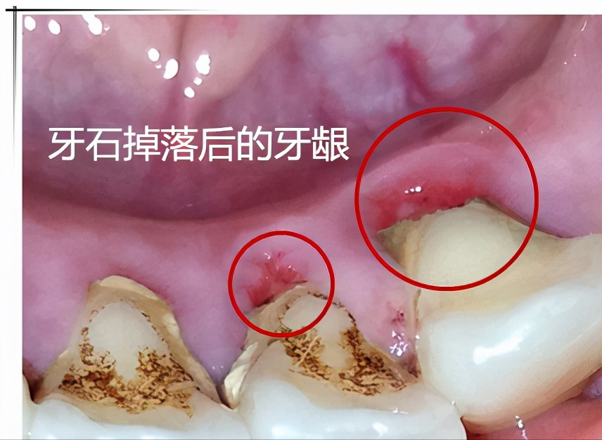 散白和2000元的洗牙费用如何区别和选择？看完告别小白