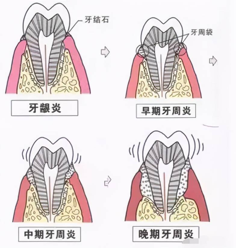 为什么普通洗牙200，深度洁牙却要2000？