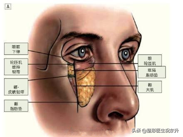 祛眼袋最全攻略，成因 方法 避雷