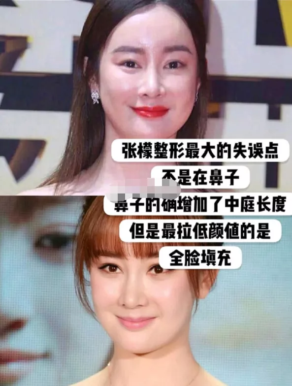 张檬颜值回春，取出鼻子假体后，面部肿胀消失，曾自曝后悔整容