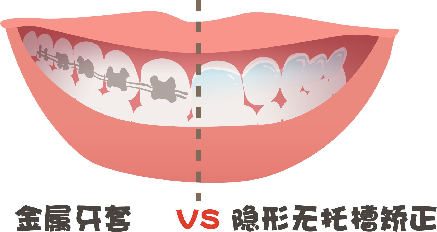 牙齿矫正，价格3000与价格20000，究竟差别在哪里