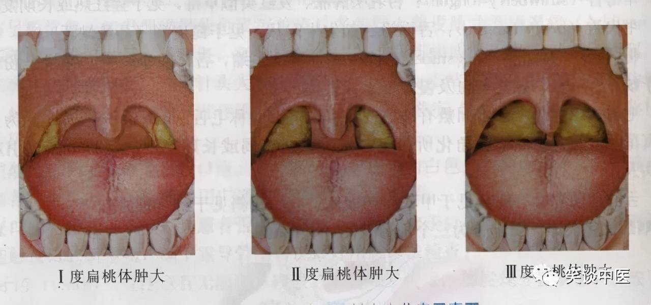喉咙发炎的图片对比图片
