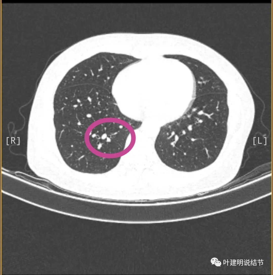 存在6年了的肺磨玻璃结节要开刀吗？