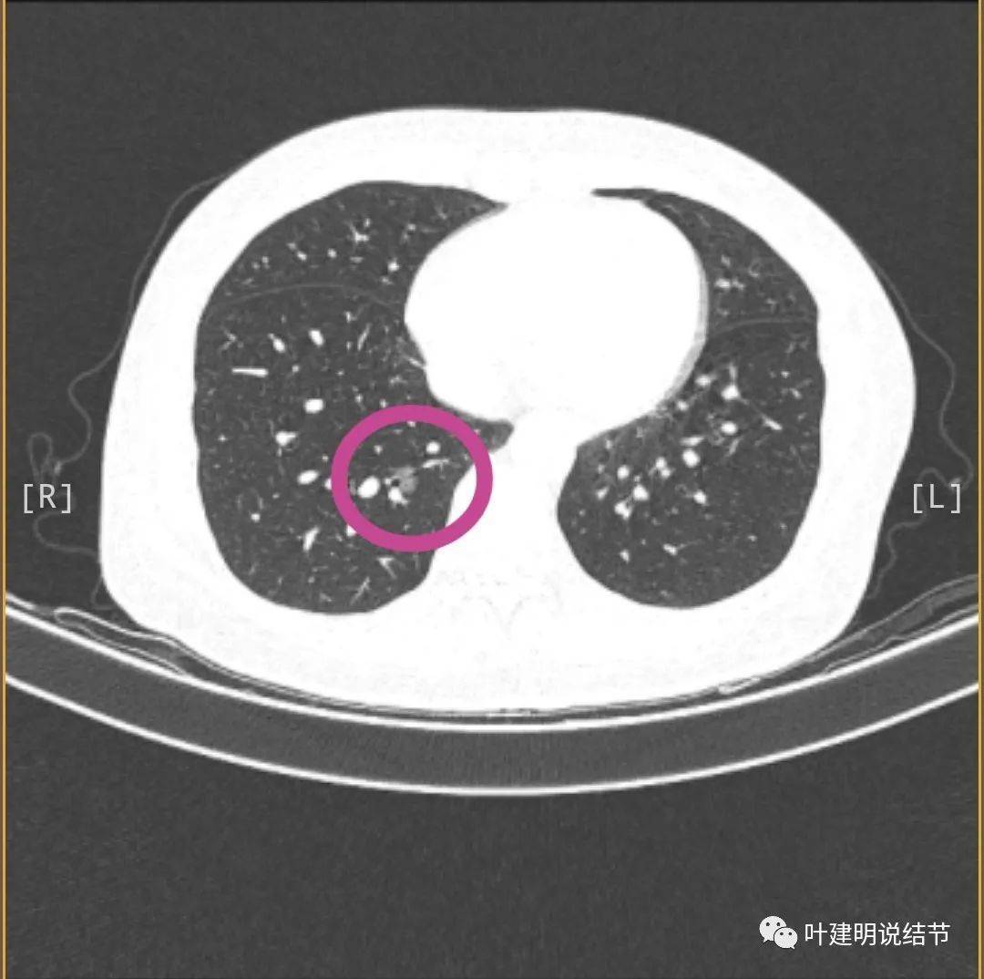 存在6年了的肺磨玻璃结节要开刀吗？