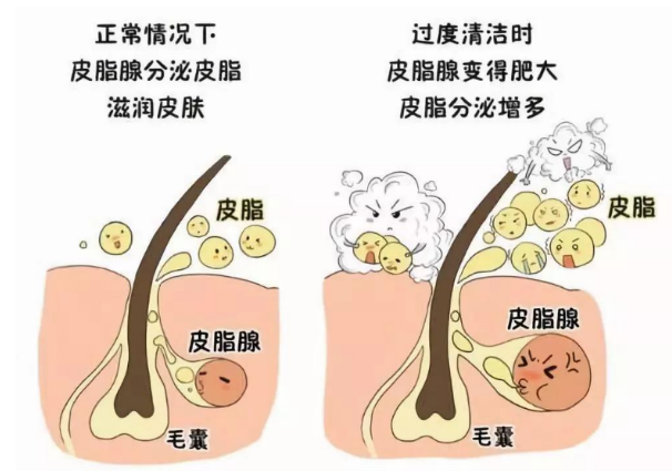 聊聊关于黑头的那些事，是不是也让你很困扰？