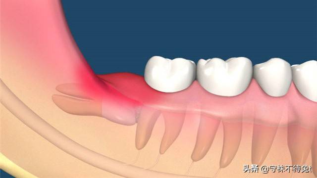 为什么不长智齿有些人不长智齿吗