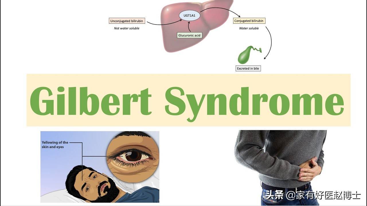 胆红素稍高一点要紧吗，哪些地方找问题？Gilbert综合征是什么？