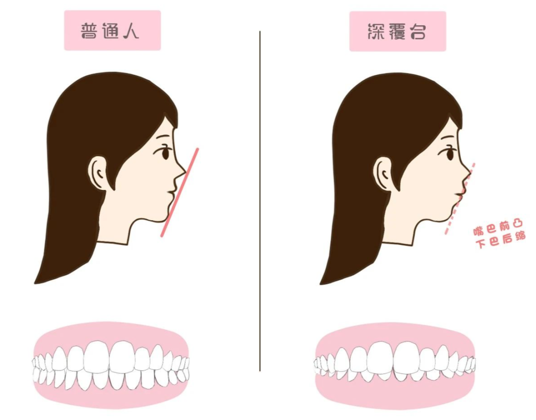 牙齿磨损有多可怕？