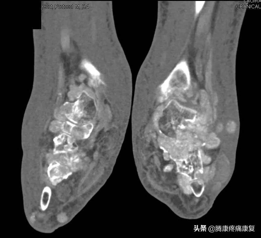 痛风解析与临床诊疗