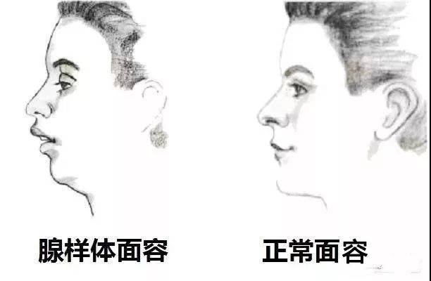 孩子睡觉打呼噜怎么办？