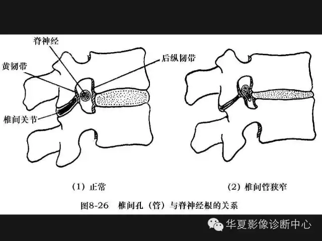 腰椎第四五节位置图图片