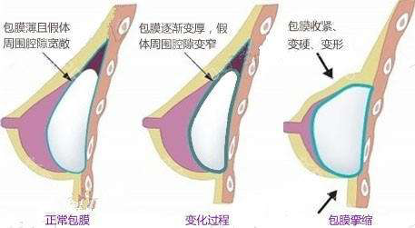 假体隆胸手术疼痛持续时间解析