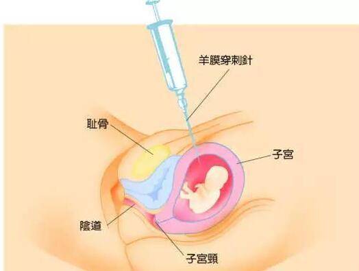 这6类孕妇需要做羊水穿刺！做羊水穿刺最佳时间？你了解多少？