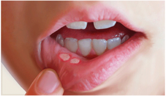 口腔癌早期有什么征兆口腔癌症的4个征兆图片